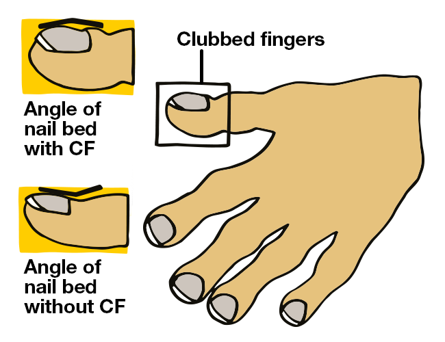 Cf what is Cystic fibrosis